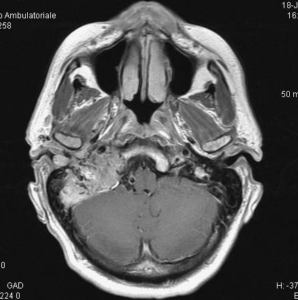 Otitis Externa Diagram