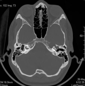 Mastoiditis