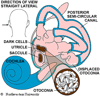 Benign Paroxysmal Positional Vertigo