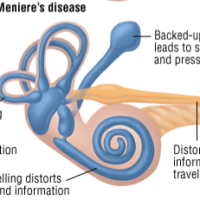 Meniere’s Disease