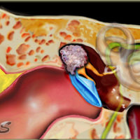 Cholesteatoma