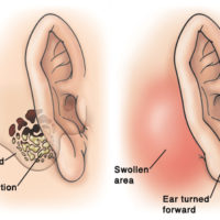Mastoiditis