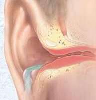 Otitis Externa