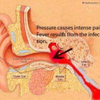 Otitis Media