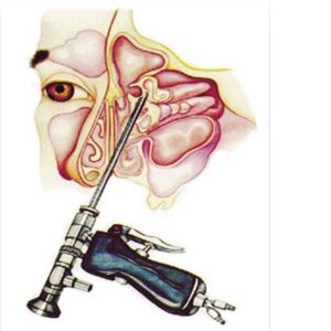 Sensorineural Hearing Loss