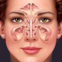 Benign Paroxysmal Positional Vertigo