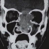 Meniere’s Disease
