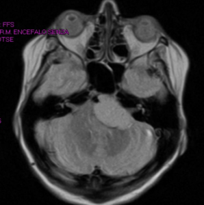 Meniere’s Disease