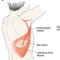 Benign Paroxysmal Positional Vertigo