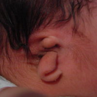 Meniere’s Disease